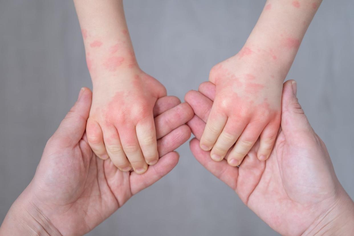 For some skin conditions, keeping hydrated is key. <a href="https://www.gettyimages.com/detail/photo/cropped-image-of-mother-holding-kids-hands-royalty-free-image/1398092187?phrase=eczema%20child&adppopup=true" rel="nofollow noopener" target="_blank" data-ylk="slk:Yuliya Shevtsova/EyeEm via Getty Images;elm:context_link;itc:0;sec:content-canvas" class="link ">Yuliya Shevtsova/EyeEm via Getty Images</a>