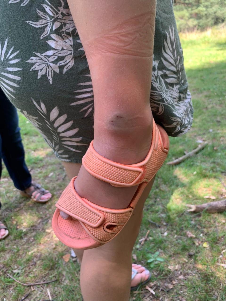 The snake bite on Lewis Wise's ankle. He was bitten in Lightwater Country Park.