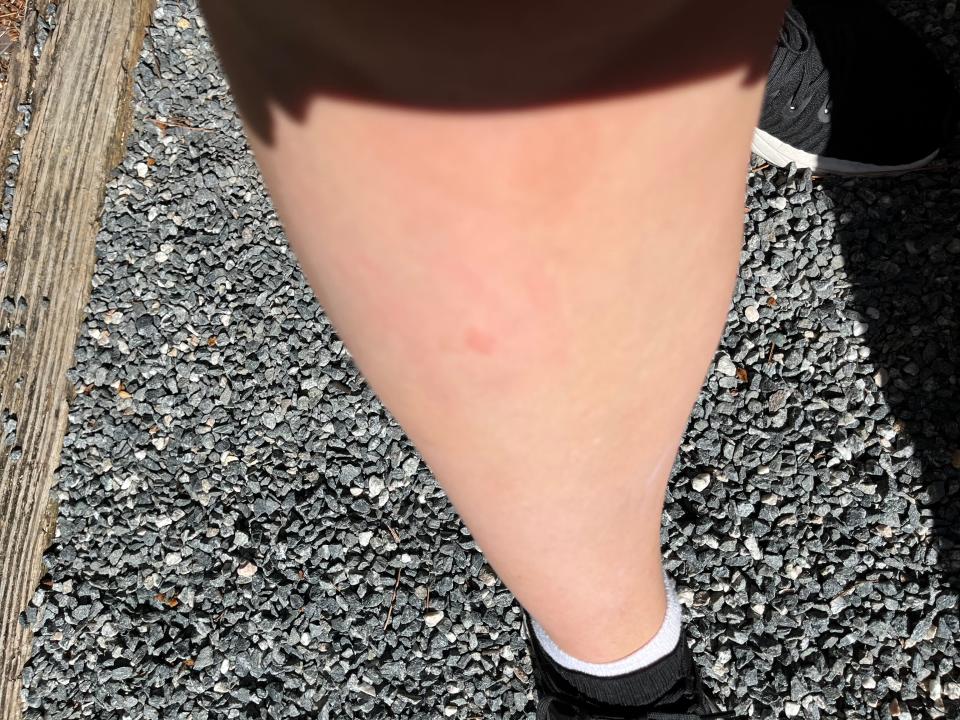 mosquito bite on leg