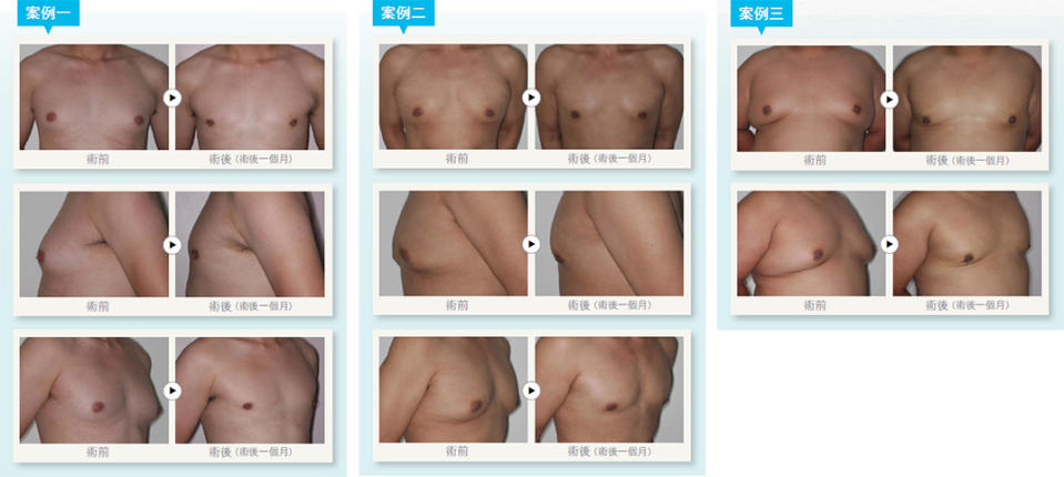 沙灘男孩 擺脫男性女乳的陰影