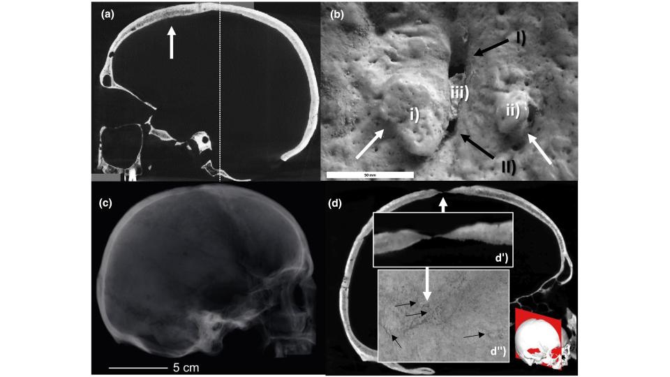 Computed tomography scans show that a hole at the top of the woman's skull was scraped through the entire bone, but had partially healed; while the scraped patch of bone on the woman's forehead had not completely penetrated her skull before she died.