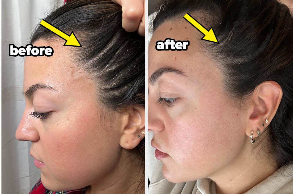 the author showing a before and after of her scalp