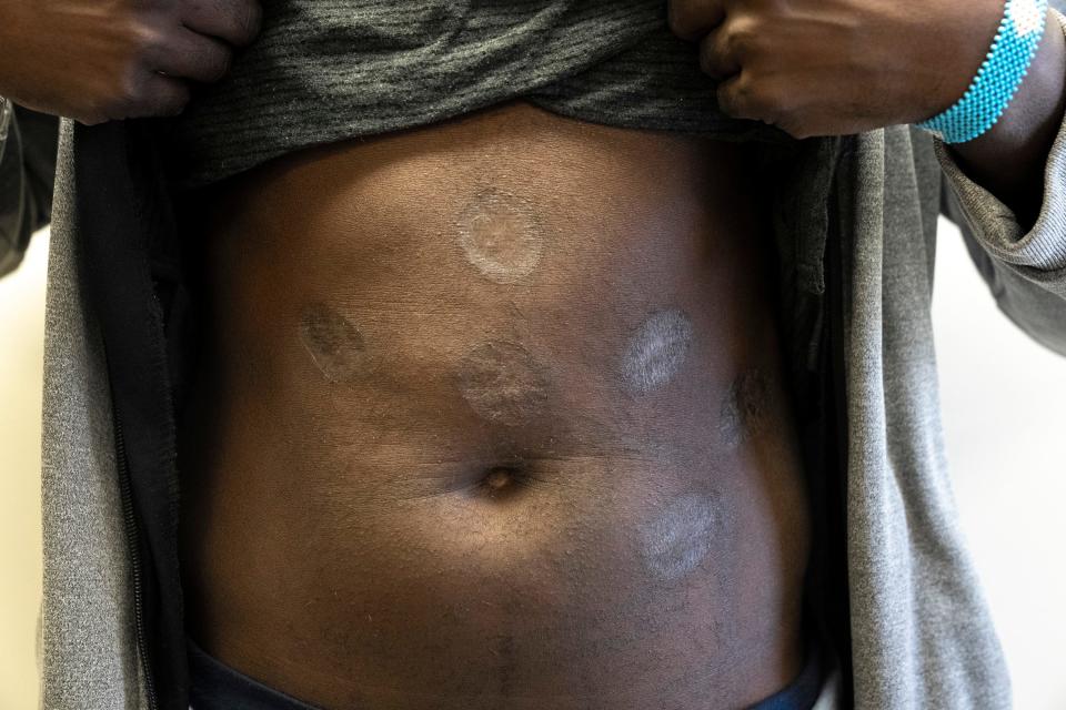 A 34-year-old Mauritanian man seeking asylum shows burn marks on his abdomen, which he sustained while being enslaved in his country. u0022I live with uncertainty, which it is torturing inside of me because I'm living a life where I'm not sure if I will be granted asylum or be deported,” he said, speaking through a Fulani interpreter.