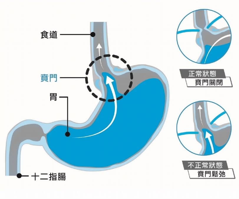 門太鬆：賁門沒關好，胃酸流向錯亂