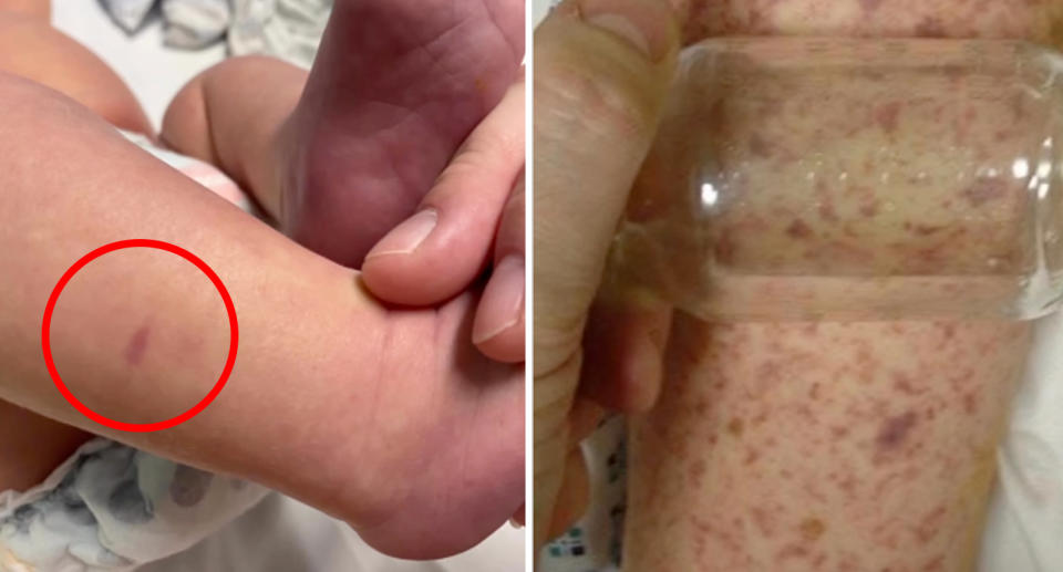 A photo of the rash on the baby's foot which ended up being Meningococcal disease.