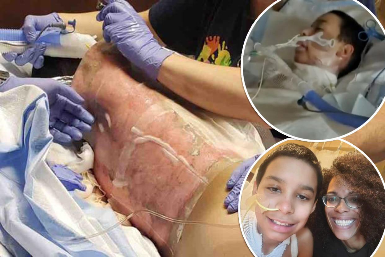 Arizona mother Tiffany Roper is warning about the dangers of social media after her preteen son Corey suffered burns all over his body during a 