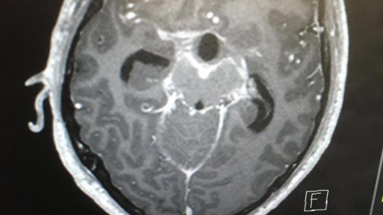 <div>Glioblastoma kills 95 percent of adults within just five years.</div>