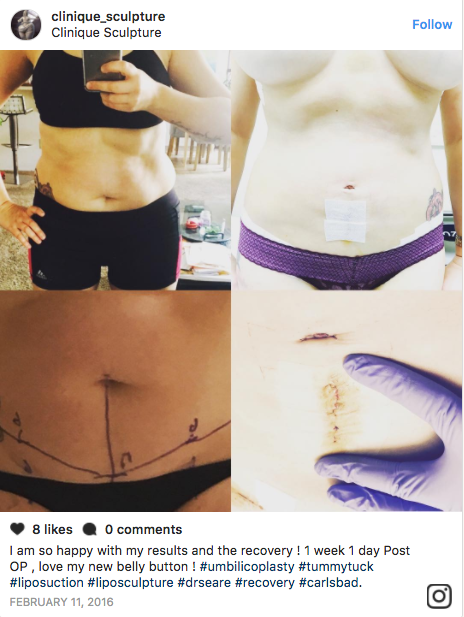 People Are Getting Plastic Surgery On Their Belly Buttons Now 