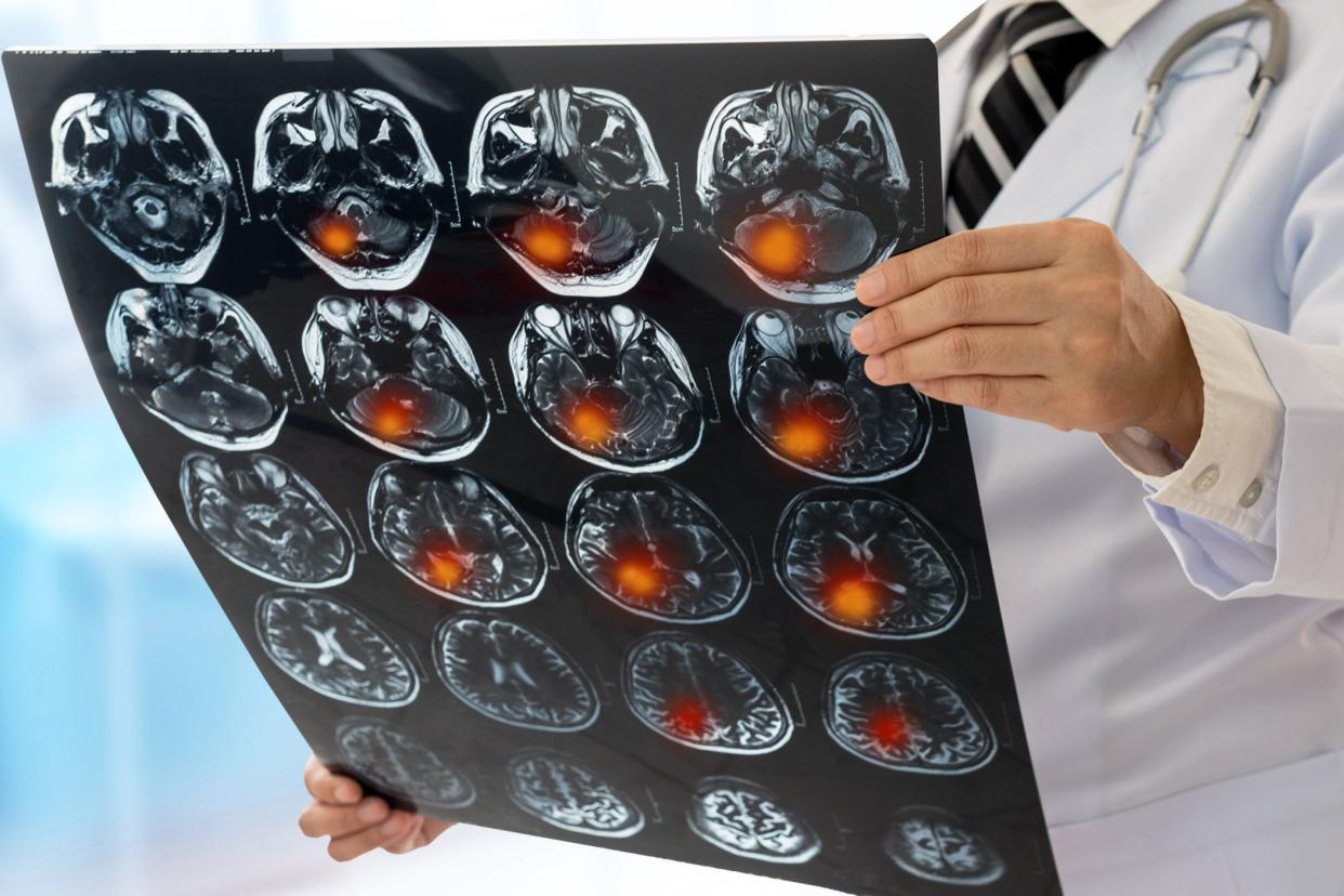 doctor holding brain scan with red spots