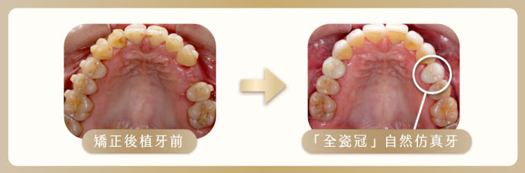 <strong>患者矯正後，牙齒架構穩定，再對缺牙處進行植牙，全瓷冠讓患者的牙齒看起來像原本的真牙一樣，且咬合適應性良好。（圖／祐民牙醫診所提供）</strong>