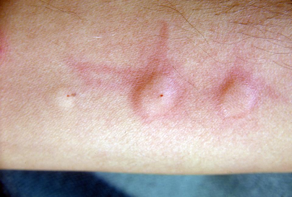 Man's arm showing positive skin test for echinococcosis. (Photo: Smith Collection/Gado/Getty Images)