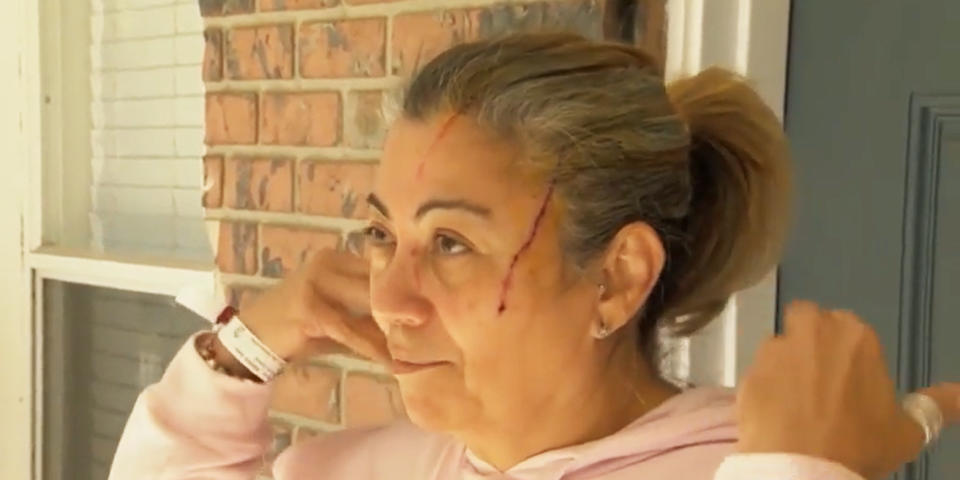 Aydee talks about being attacked by a bear in Volusia County, Fla. (WESH)