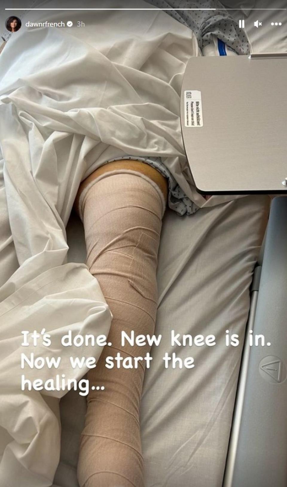French shared a photo of her bandage leg on her Instagram Story (Instagram/Dawn French)