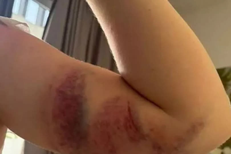 Horrific pictures show bruising on her arms