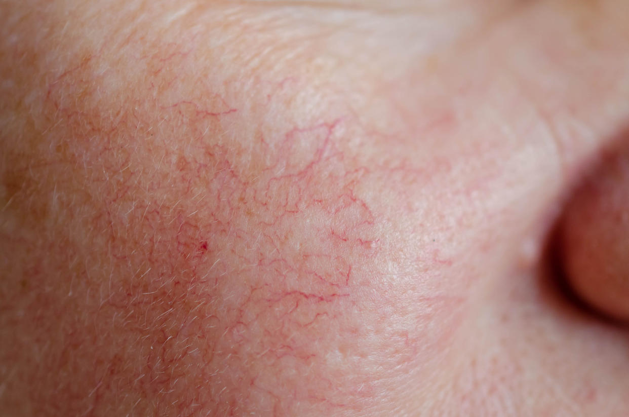 Pictures of rosacea skin condition and about rosacea treatment (Getty Images stock)