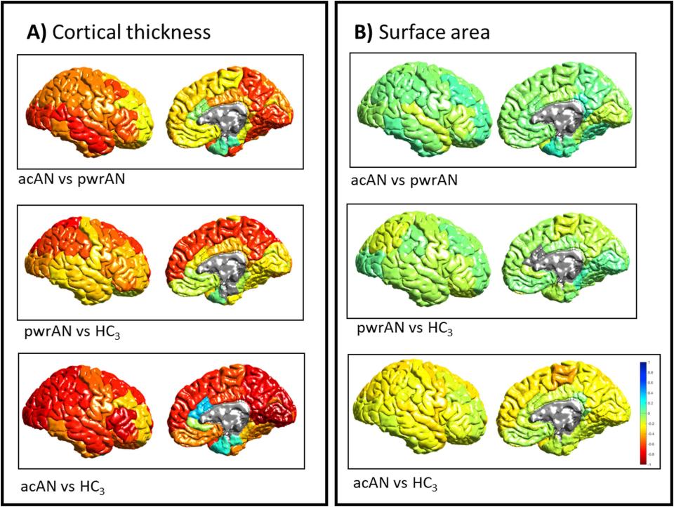 Anorexia brain scans