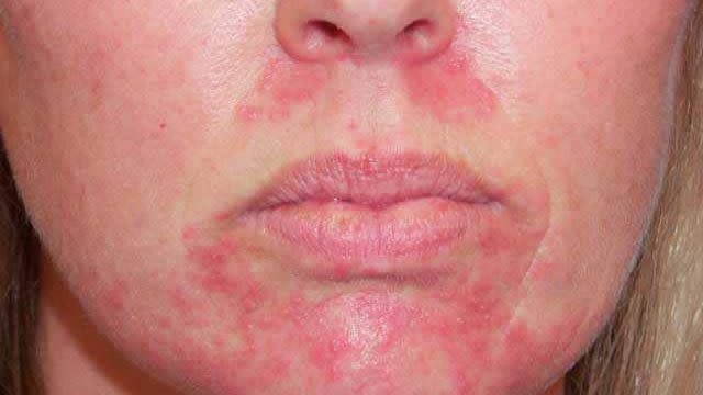 perioral dermatitis