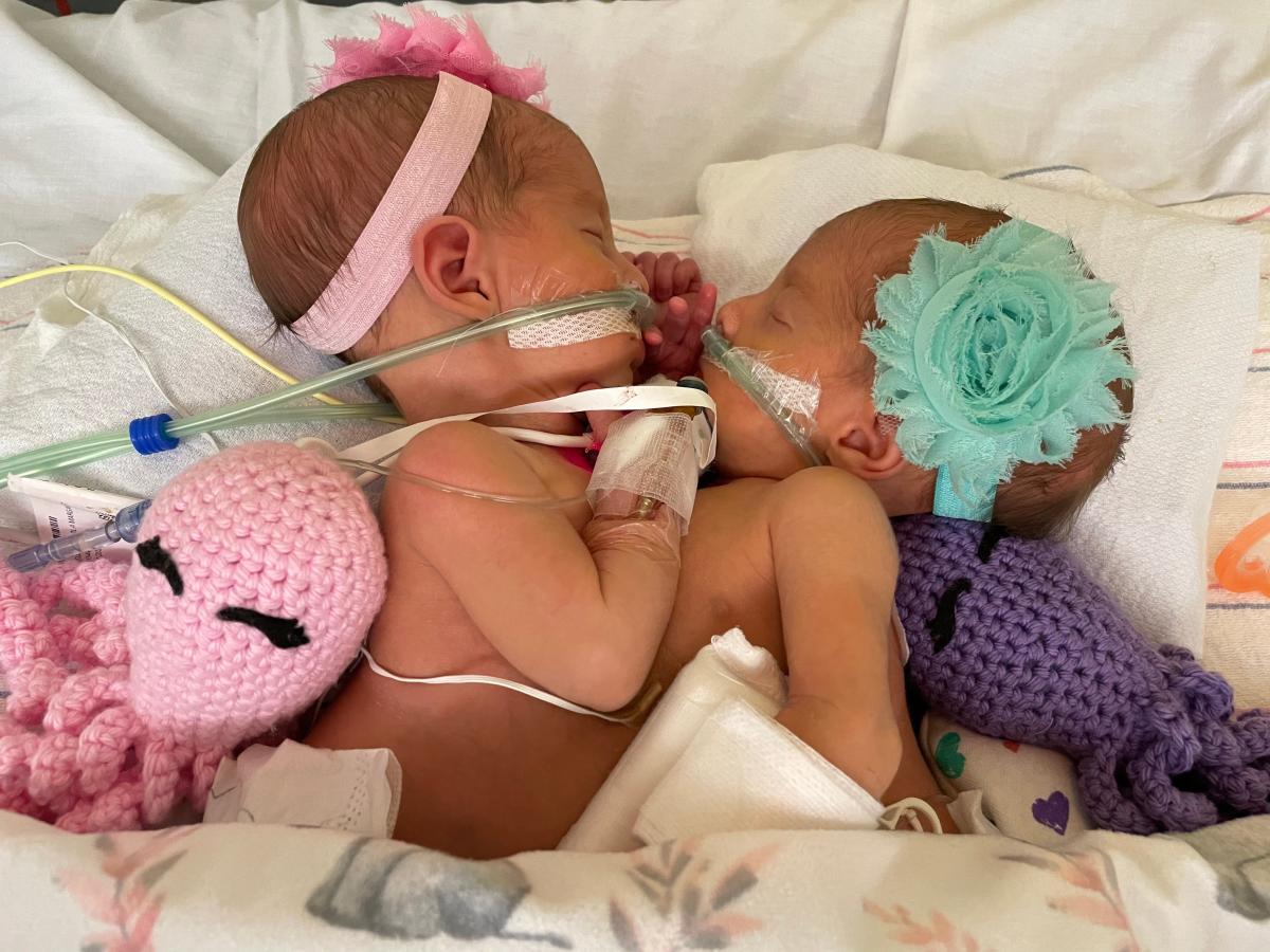 How are the Altobelli conjoined twins doing today? All the details 