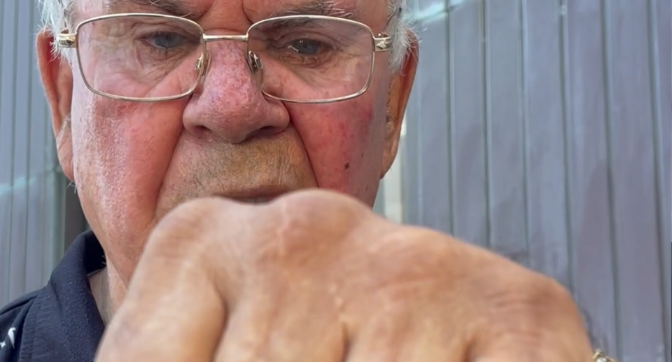 James Michael Widdy Welsh shows his scarred knuckles to the camera. His face can be seen behind.