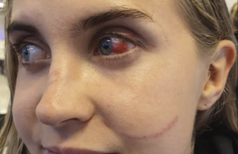 La futbolista finlandesa Ria Öling compartió una foto en sus redes sociales de la herida en el ojo que le fue infligida por las uñas postizas de una oponente durante un juego que su equipo ganó por 6-0 (Foto: Captura de la cuenta de Instagram @riaoling)