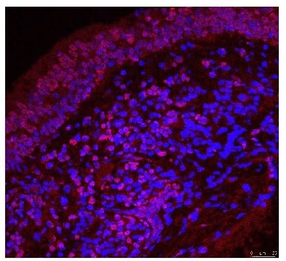 顯微鏡下，息肉組織充滿嗜酸性白血球，於免疫螢光染色中呈現亮藍色。（圖／林口長庚醫院提供)）