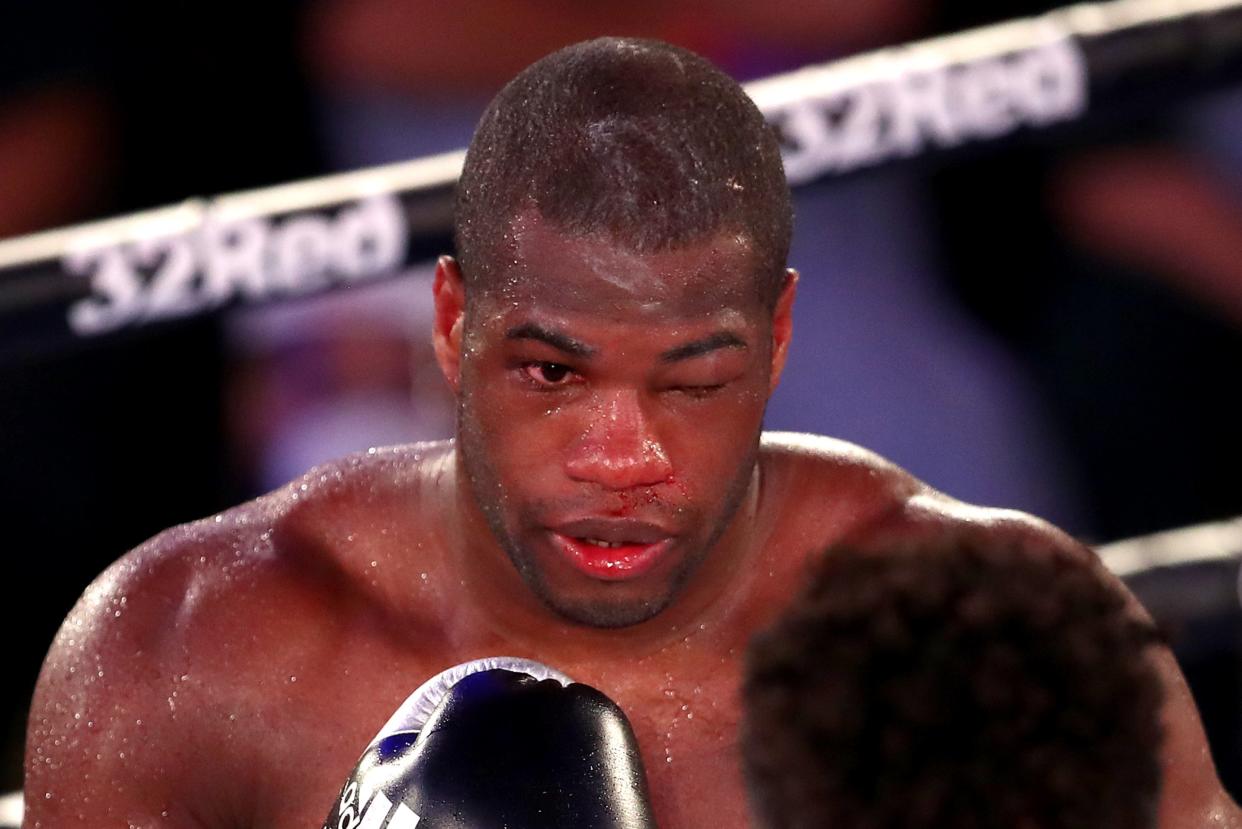 <p>Daniel Dubois suffered a broken orbital bone and nerve damage around his left eye against Joe Joyce</p> (Getty Images)