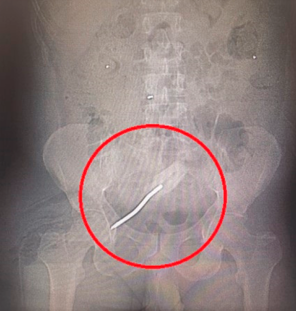 Screwdriver inside the bottom of a Florida man that caused life-threatening septic shock.