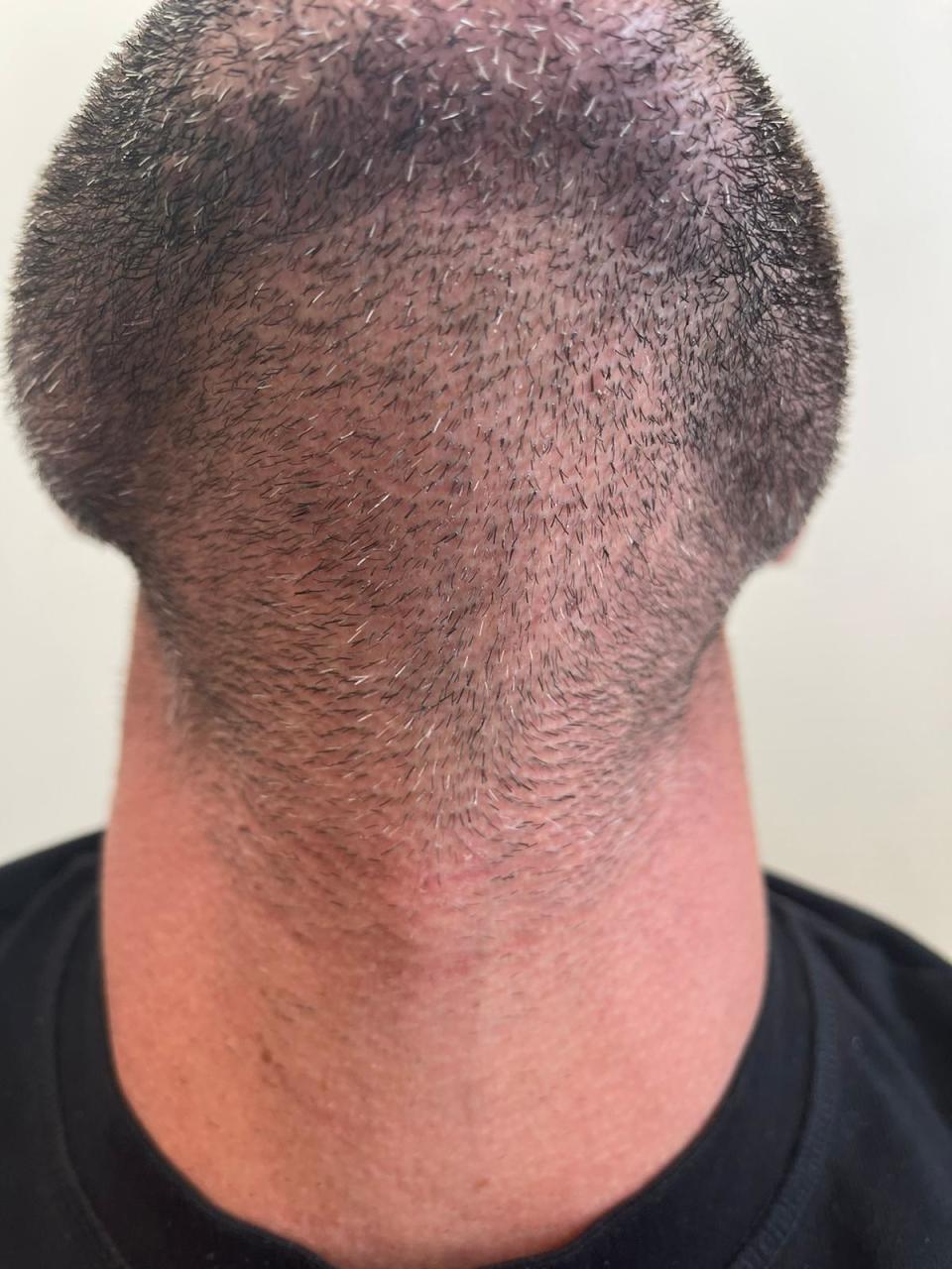Calum Best’s neck where donor hair was extracted for his hair transplant with the neck scars fully healed two weeks after his hair transplant (Vincent Cole)
