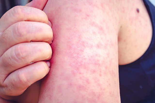 <p>Getty</p> Measles on the arm.