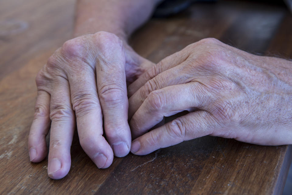 Hands of man with psoriatic arthritis. (Getty Images)