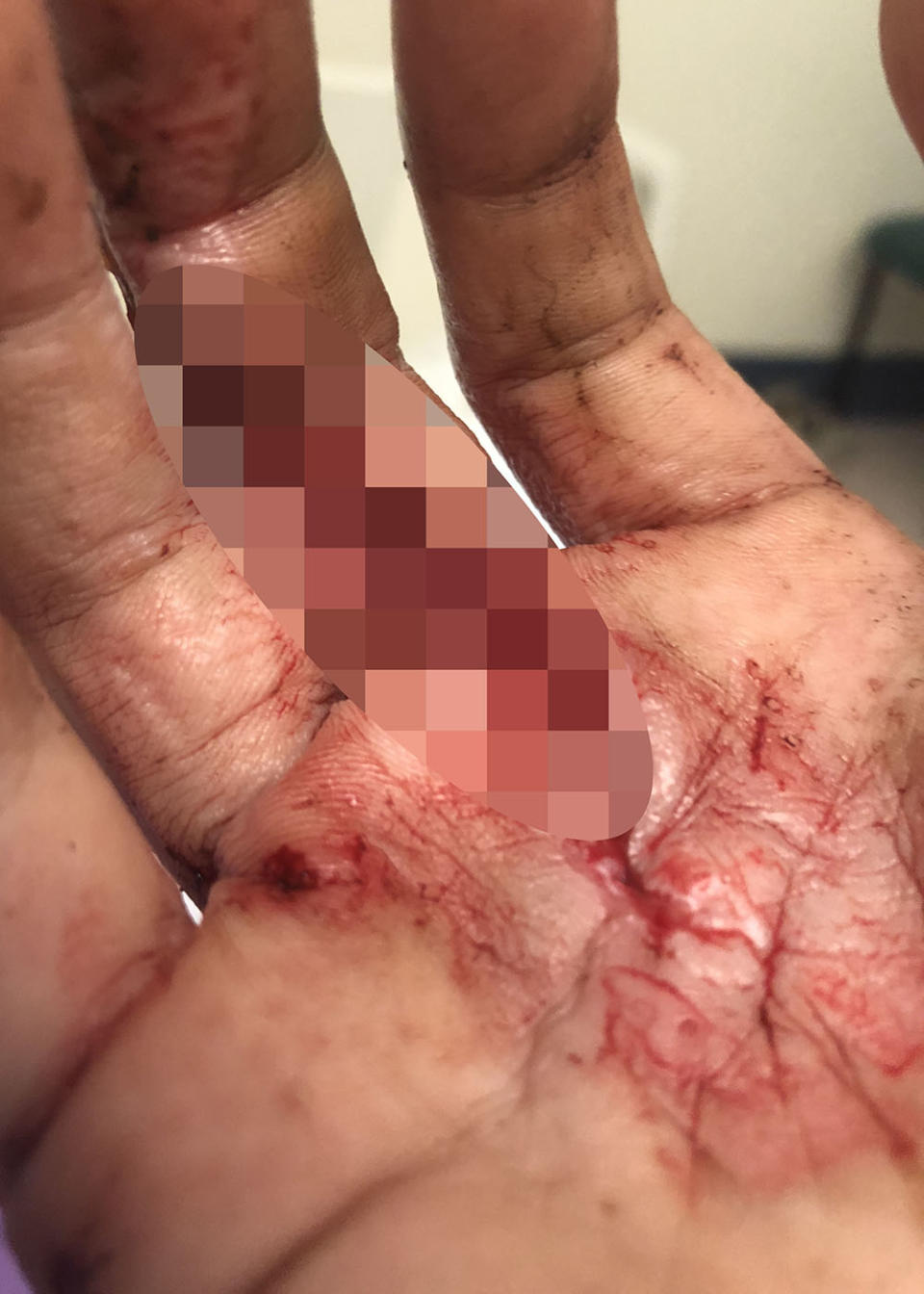 Sarah Wylie’s hand injury, which she sustained as she fell down the mountain in Queensland. Source: Caters