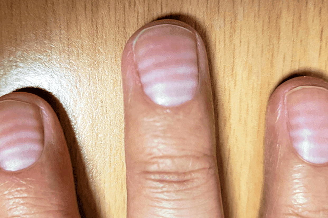 Les ongles d'un trentenaire britannique ont passionné la communauté scientifique pendant des mois.  - Credit: