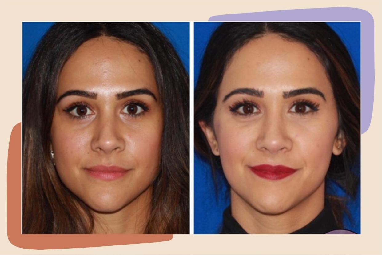 under eye fillers