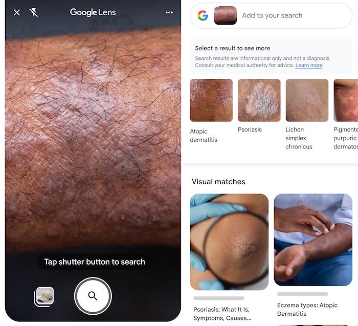 Google Lens shows image options for what a skin condition might be. 