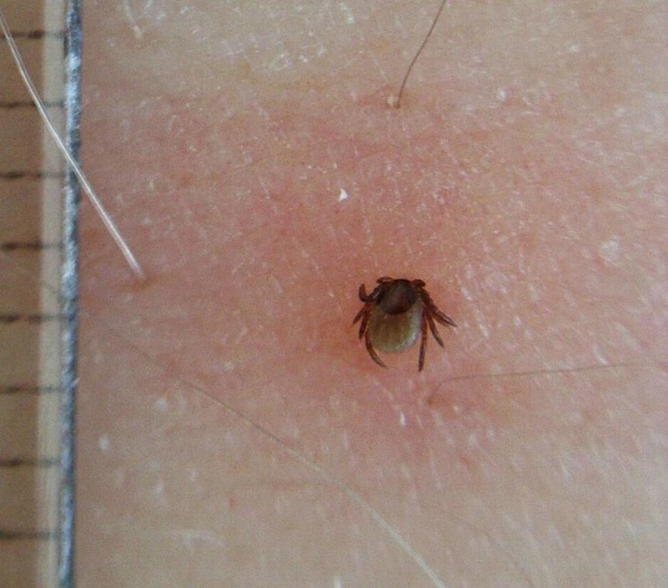 A tick latched to the skin is seen in this file photo. (Photo shared under Creative Commons license via Wikimedia Commons.)