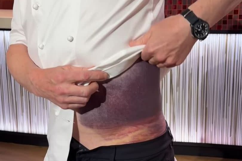 Gordon Ramsey showing the injuries he sustained in a bike accident -Credit:Gordon Ramsey