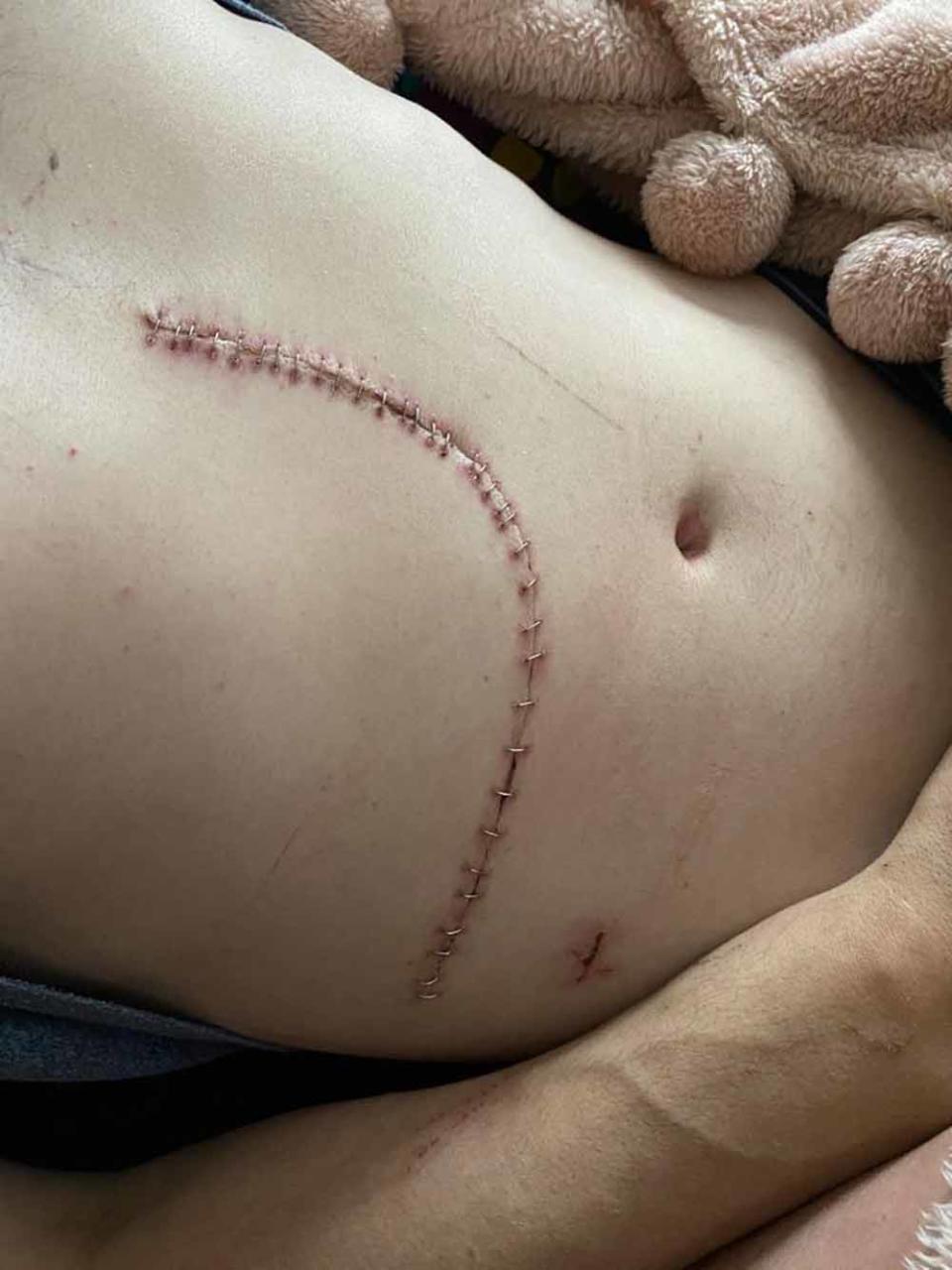 Owen’s cancer surgery scar from his liver resection in August 2020. PA REAL LIFE COLLECT