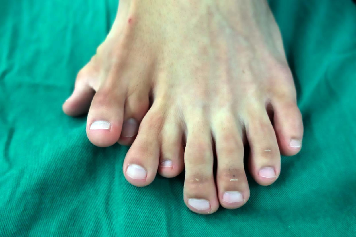 The 21-year-old man wass born with nine toes on one foot. (AsiaWire)