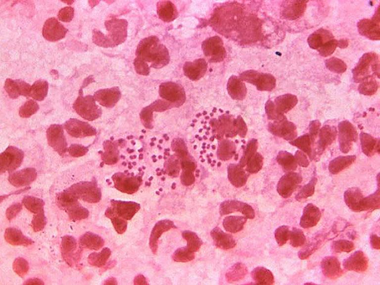 What is super-gonorrhoea, what are the symptoms and how can it be treated?