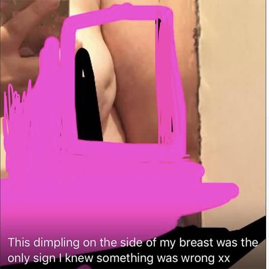 Sherrie noticed a dimple in her right breast when she was trying on a swimming costume. Photo: Facebook