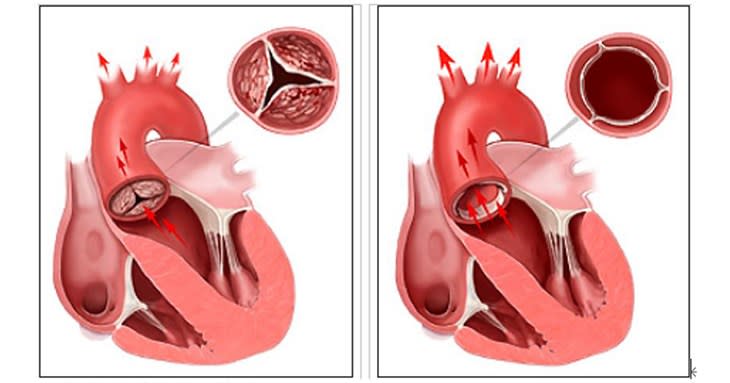 主動脈瓣膜狹窄示意圖（圖片提供／亞東醫院）