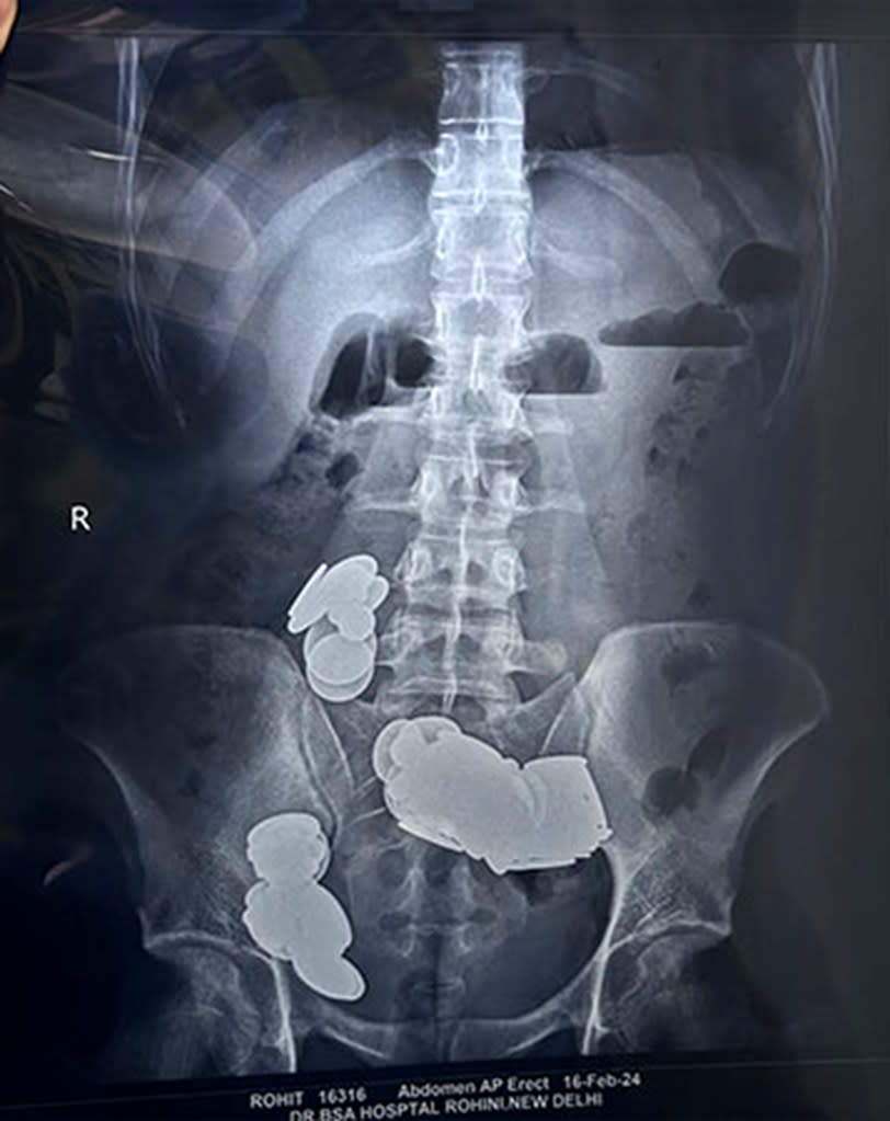 X-rays from a 26-year-old patient in New Delhi show large metallic clots forming in his intestines after he ate dozens of coins and magnets. Sir Ganga Ram Hospital