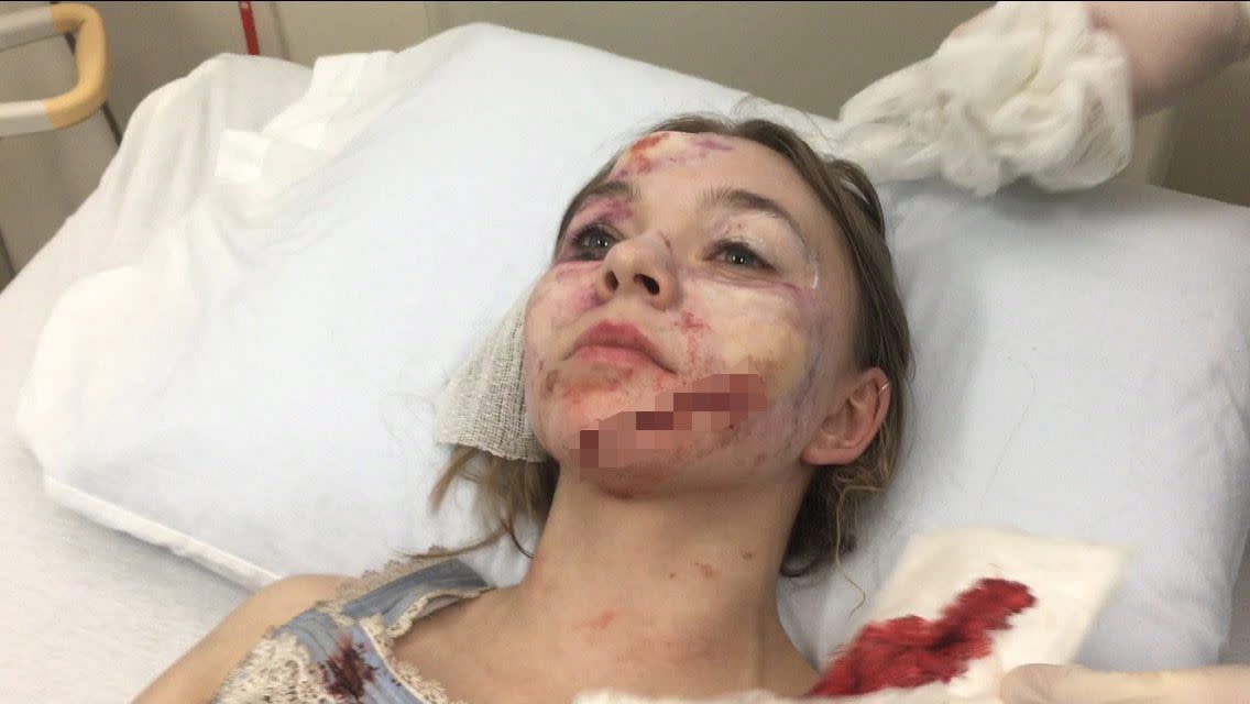 Actress Taylor Hickson is suing the production company of an upcoming indie horror film after she suffered a face-disfiguring injury on set. The 20-year-old filed the suit against Incident Productions after pounding into a glass pane and having it shatter into her face, the suit said. Hickson required about 70 stitches following the gruesome injury. The director of the film allegedly asked her to pound harder on the pane that later broke, the suit said. "The crafts services lady held my face together with napkins in her hands," Hickson told Deadline. "She went through so many napkins, there was so much blood."