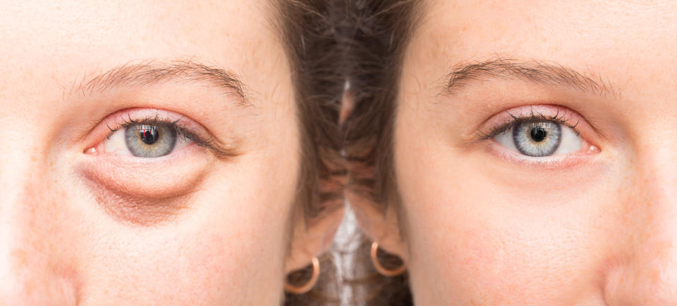 under-eye bags before and after