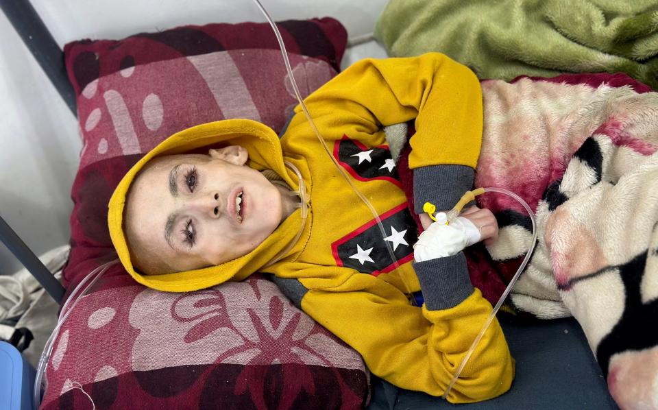 Yazan Al-Kafarna, a Palestinian boy who had cerebral palsy and died due to malnutrition, according to a Gaza doctor, lies on a bed at Al-Awda health centre