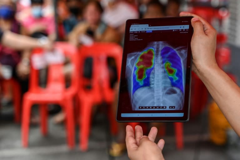 Un travailleur médical montre le résultat d'une radiographie lors d'un dépistage de la tuberculose dans un centre de santé à Valenzuela, aux Philippines, le 14 mars 2024 (JAM STA ROSA)