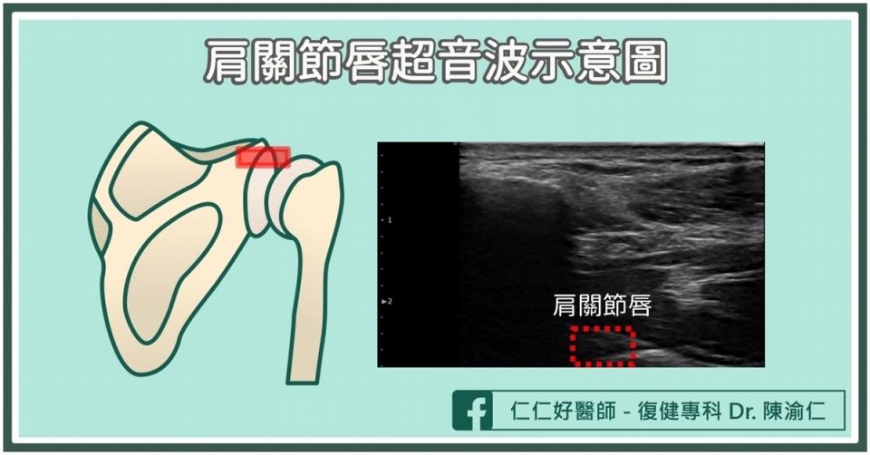 「肩關節唇」是什麼？