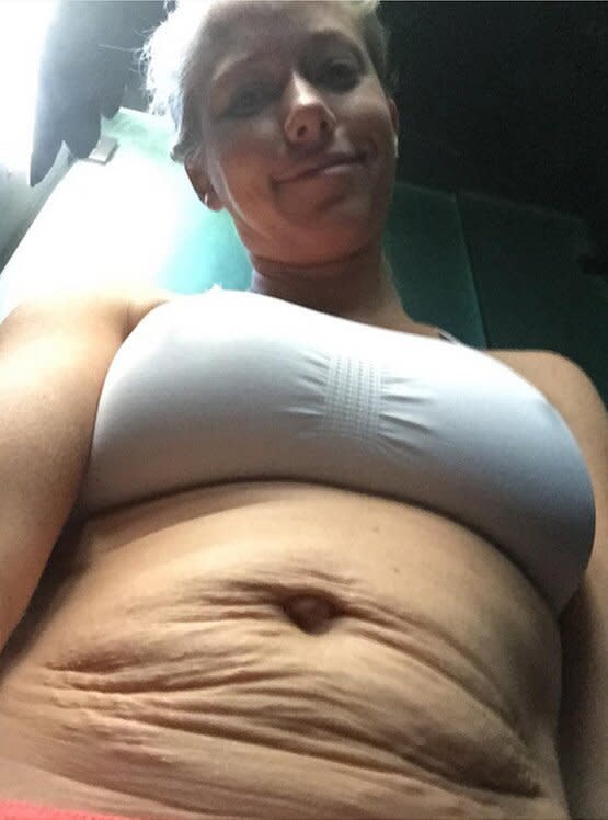 kendra wilkinson stretch marks