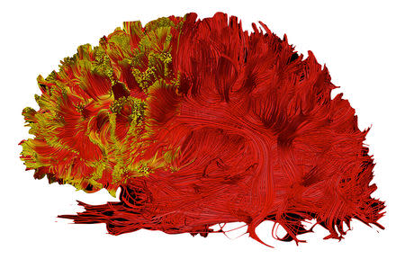An illustration provides a 3D graphical representation of the altered connections, visualised with diffusion tractography (yellow tint), that are important for executive functions in people with ADHD, as created with MRI technique pioneered by Professor Marco Catani at King's College London in this handout image obtained by Reuters May 21, 2019. PROFESSOR MARCO CATANI, KING’S COLLEGE LONDON/Handout via Reuters