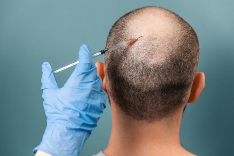 Alopecia areata